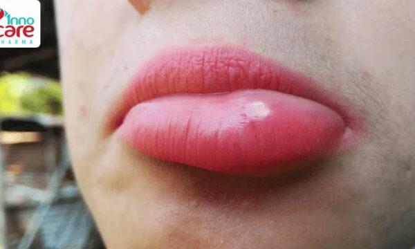 Mẹo xử lý khi bị muỗi đốt vào môi hiệu quả nhanh