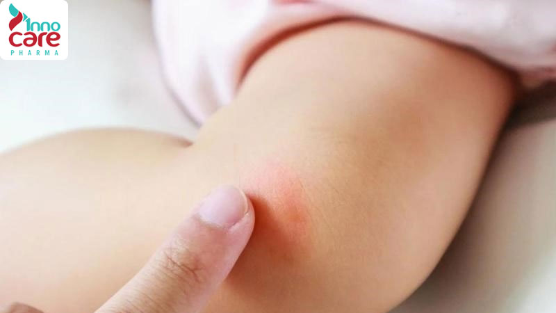 Mẹo trị vết muỗi đốt lâu lành và bị thâm, đỏ hoặc loét