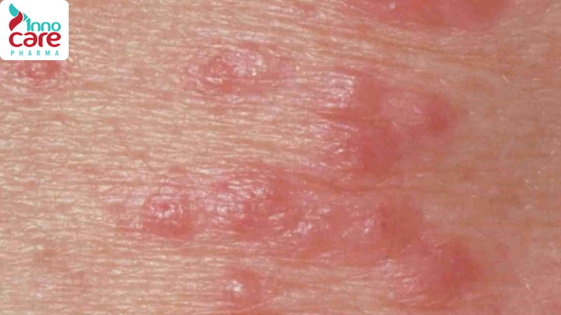 Mẹo trị vết muỗi đốt lâu lành và bị thâm, đỏ hoặc loét