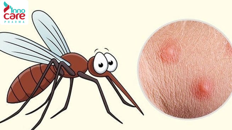 Làm gì để nhanh hết vết muỗi đốt bị sưng đỏ?