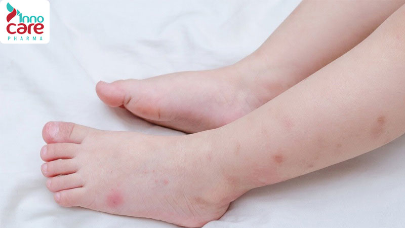 Mẹo trị vết muỗi đốt lâu lành và bị thâm, đỏ hoặc loét