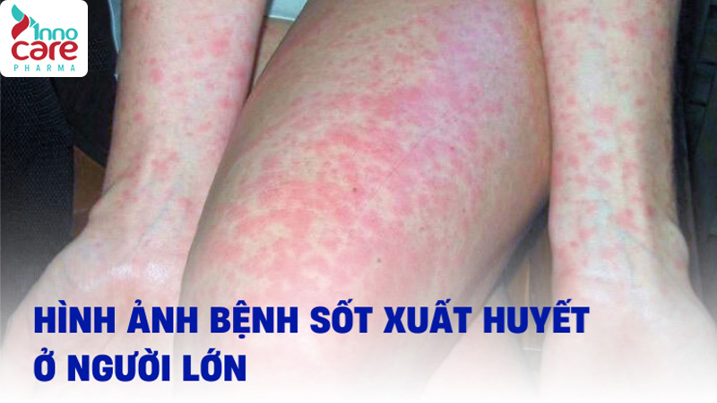 Muỗi “độc” thường lây truyền những bệnh nào? 1 Dấu hiệu bị muỗi độc đốt sưng to và cách xử lý nhanh nhất