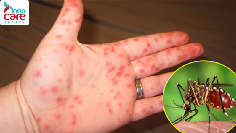 Dấu hiệu bị muỗi độc đốt 1 Dấu hiệu bị muỗi độc đốt sưng to và cách xử lý nhanh nhất