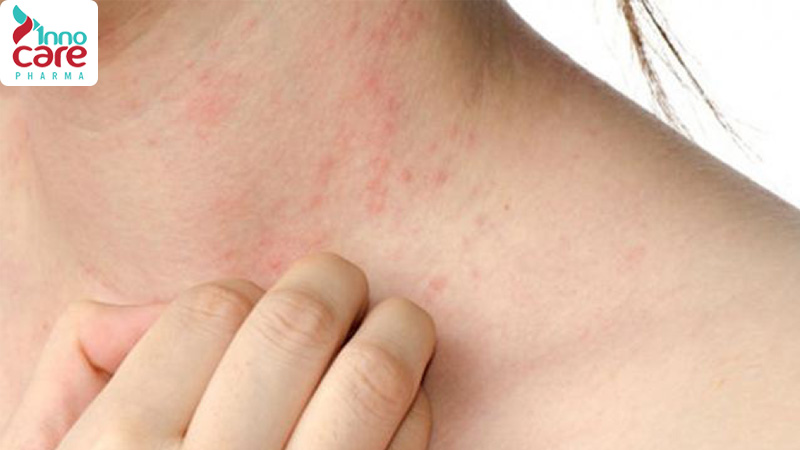 Nên làm gì khi bị muỗi đốt ngứa nhiều ngày liên tục? 1