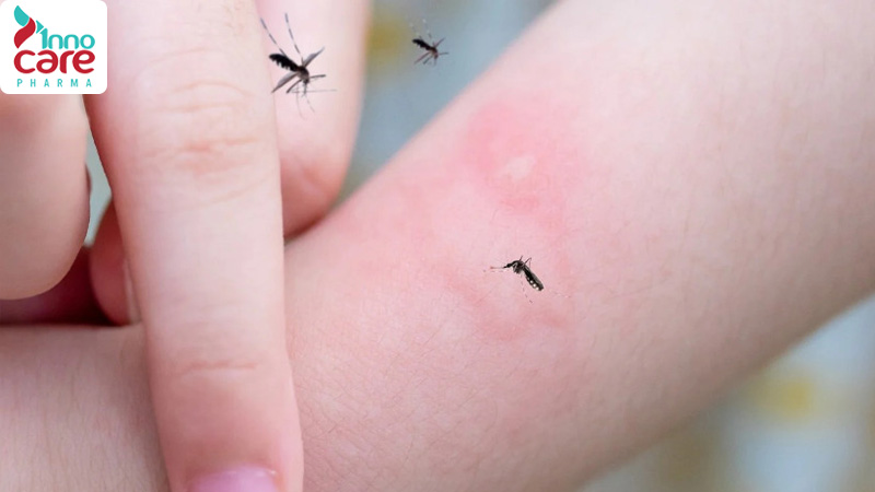 Muỗi đốt ngứa nhiều ngày có sao không?