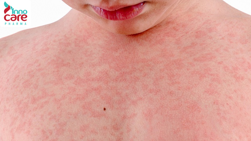 Đốt và hít khói nhang muỗi có độc không? Cần lưu ý gì?